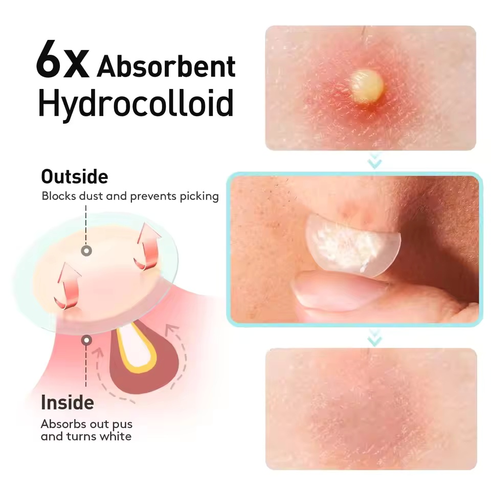透明ハイドロゲルニキビパッチ、アルコールフリー、低刺激性吸収 - Face Oil のレビューと価格